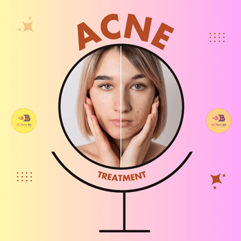 Acne Treatment