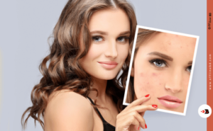 Siodil Sebi Anti Acne Bar