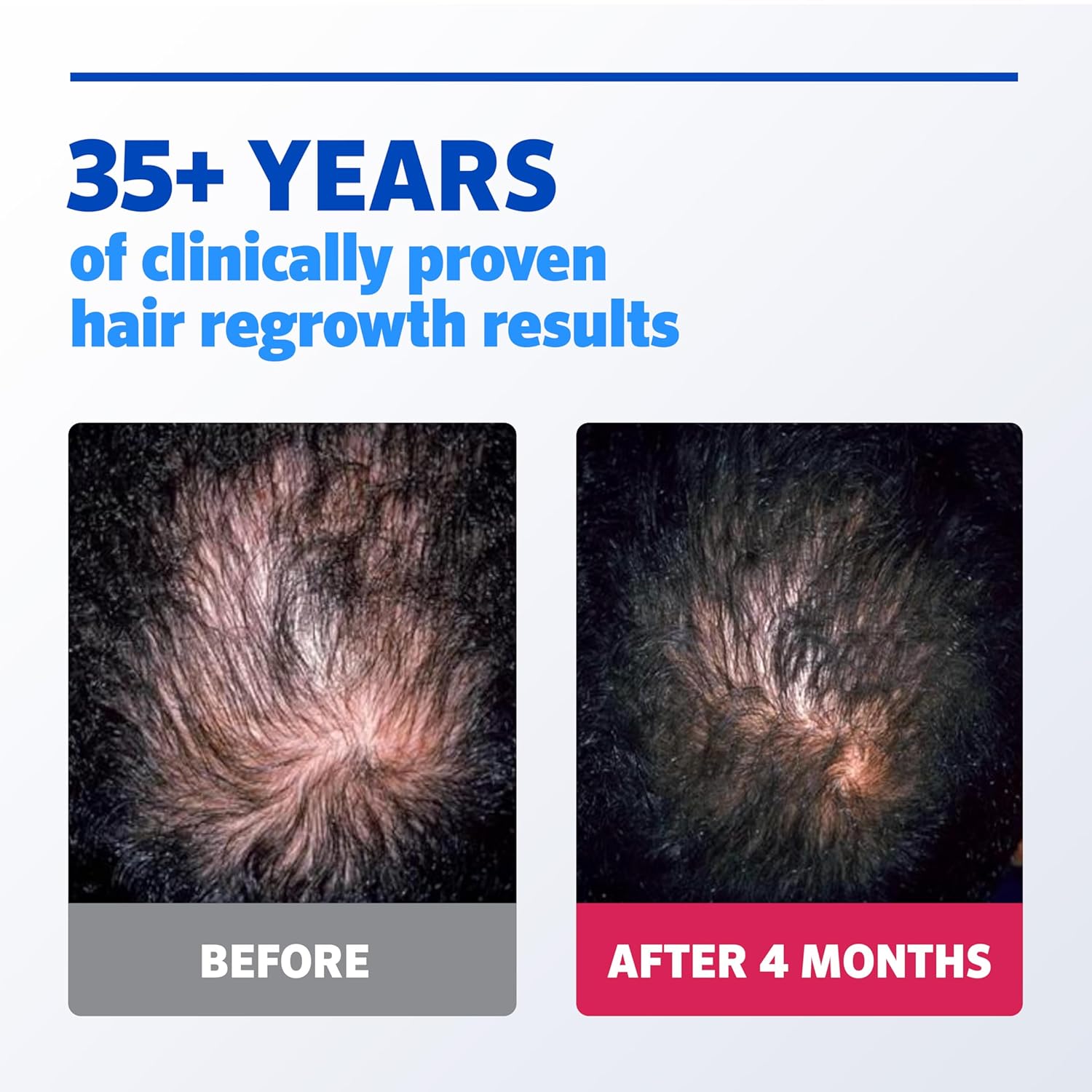 Men’s Rogaine 5% Minoxidil Solution for hair regrowth